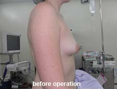 plastic-surgery-breast-augmentation 
